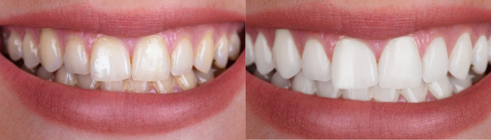 Antes e depois de clareamento dental
