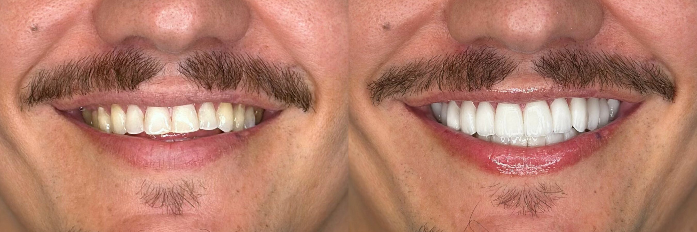 Antes e depois de facetas de porcelana