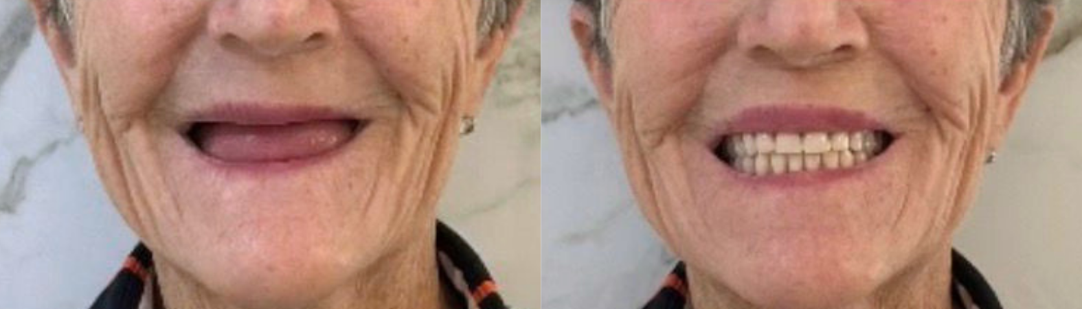 Antes e depois de implante dentário